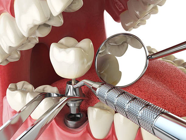 Best Knocked-Out Tooth Emergency  in Valley, NE